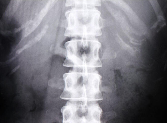 脊椎・脊髄外科 佐々木整形外科 spine clinic 広島市安佐南区祇園